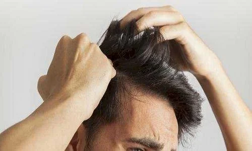 طرق للتخلص من قشرة الشعر نهائيا