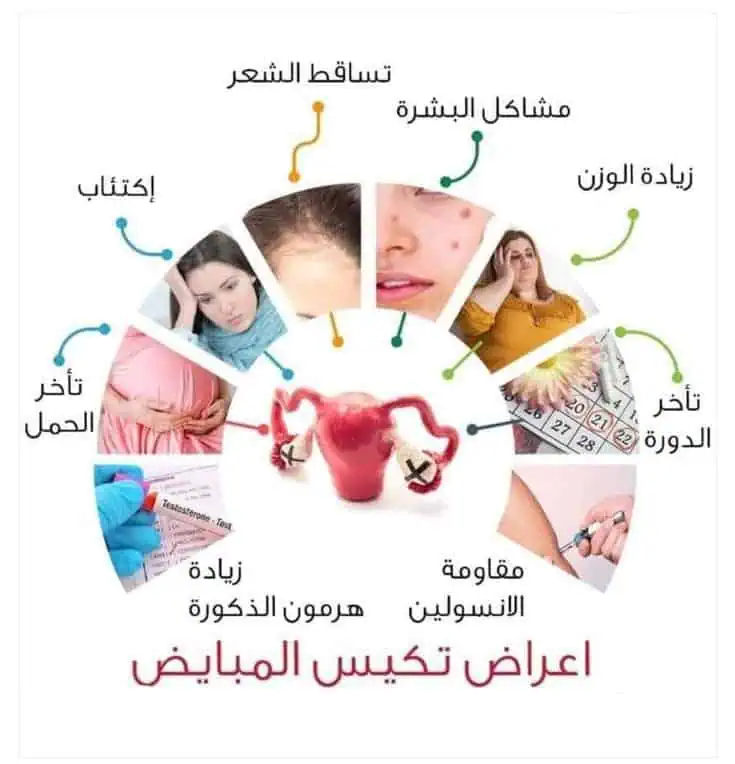 قصة حقيقية من السعودية اختفاء تكيسات المبايض مع DXN