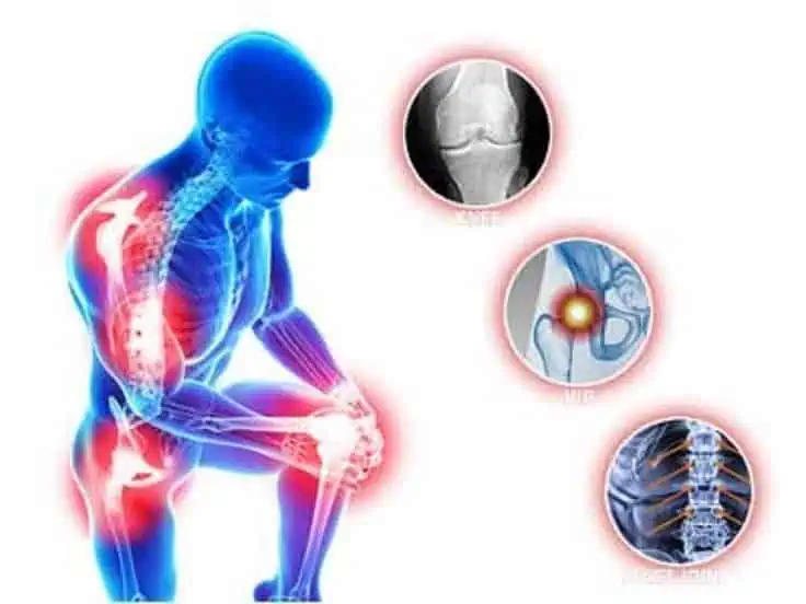 قصة تحسن من الروماتويد باستخدام المكملات الطبيعية